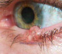 Pre - Operative photo of basal cell carcinoma of the left lower lid